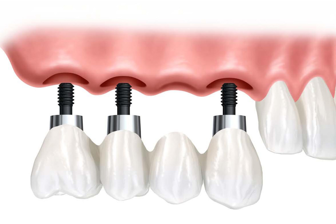 Dental Implants in Mexico Tijuana